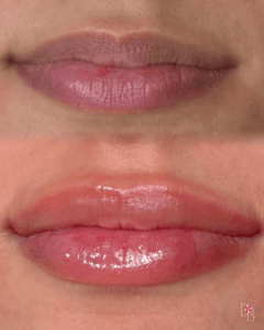 Lip Blushing Toronto and Lip Blush Richmond Hill Before After