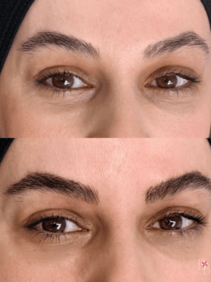 Nanoblading Before After Nanoblading Before After