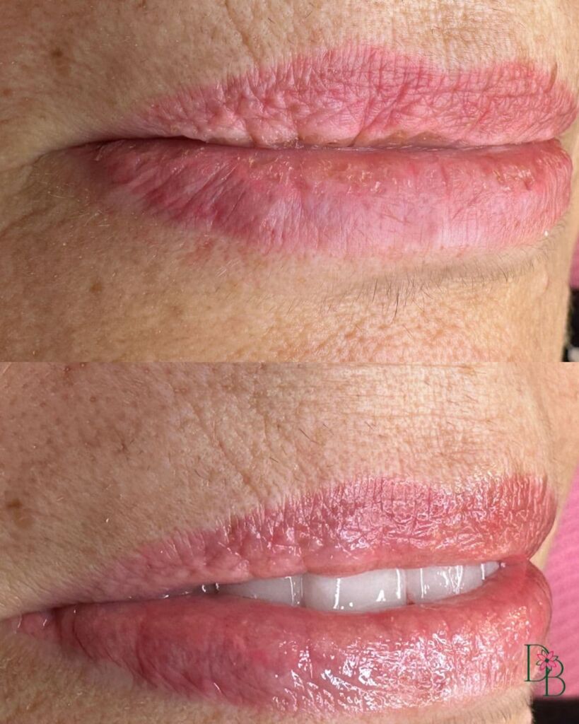 daphne beauty hydralips before after v2