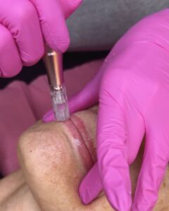 daphne beauty hydralips before after v3