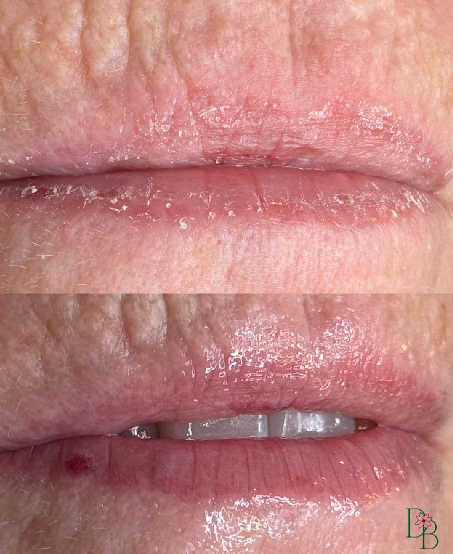daphne beauty hydralips service toronto