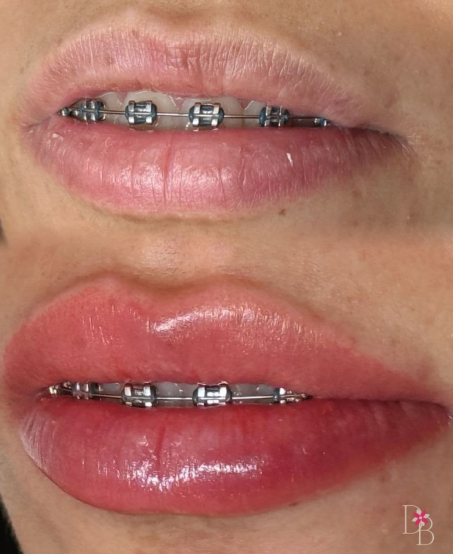 daphne-beauty-lip-blushing-and-neutralization-cover-richmond-hill